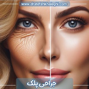 جراحی پلک در اهواز - دکتر عاطفه خالقی