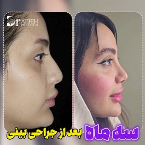 نمونه کار بهترین جراح بینی اهواز - dratefehkhaleghi.com