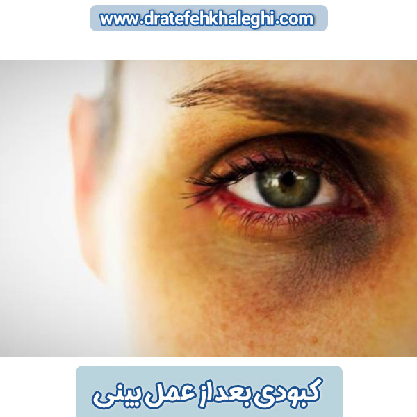 کبودی بعد از عمل بینی 