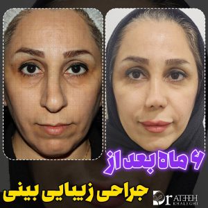 نمونه کار های بهترین جراح بینی اهواز - https://dratefehkhaleghi.com/