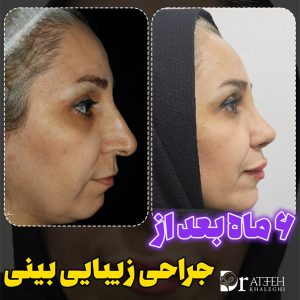 نمونه کار های بهترین جراح بینی اهواز - https://dratefehkhaleghi.com/