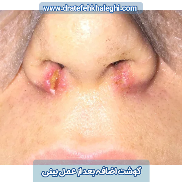 گوشت اضافه بعد از عمل بینی 