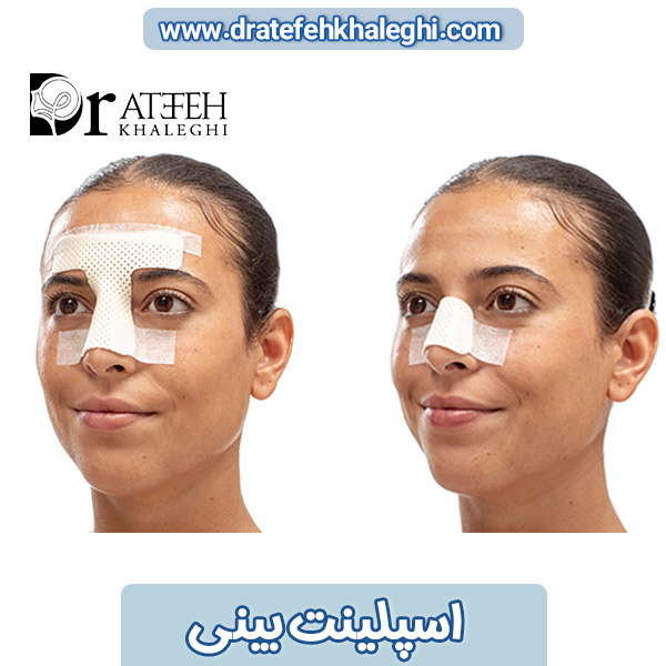 اسپلینت بینی 