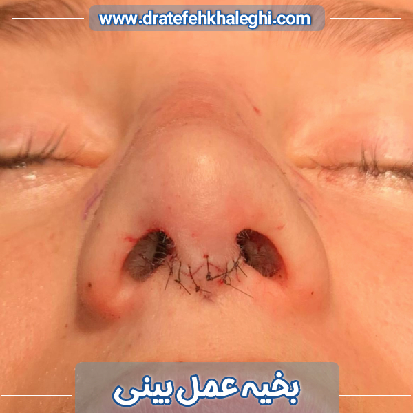 بخیه بینی بعد از عمل - دکتر عاطفه خالقی