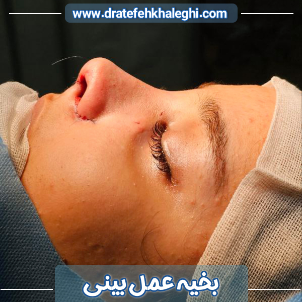 بخیه بینی بعد از عمل - دکتر عاطفه خالقی