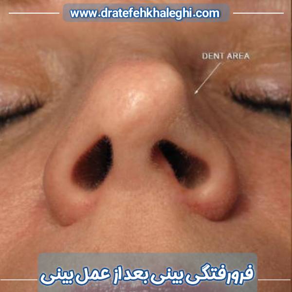 فرورفتگی بینی بعد از عمل