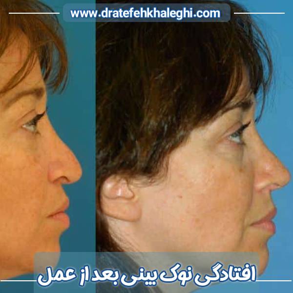 افتادگی نوک بینی بعد از عمل