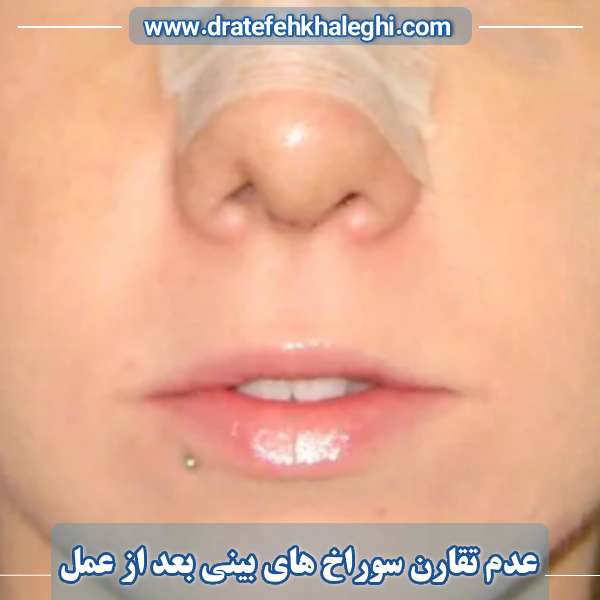 عدم تقارن سوراخ ‌های بینی بعد از عمل