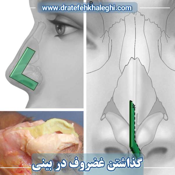 گذاشتن غضروف در بینی